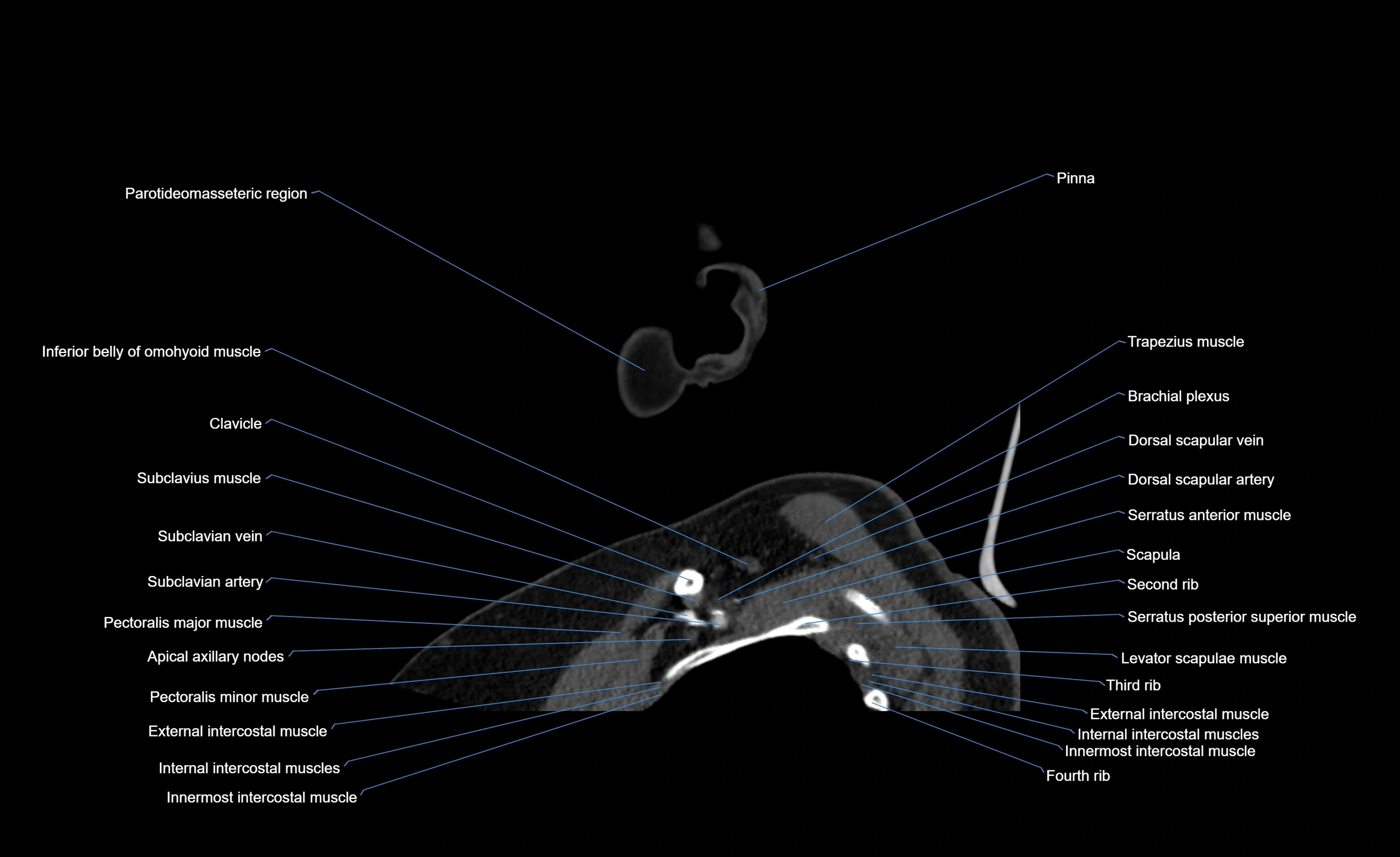 Neck CT sagittal cross sectional anatomy 3D  radiology  image-img-00001-00028.webp